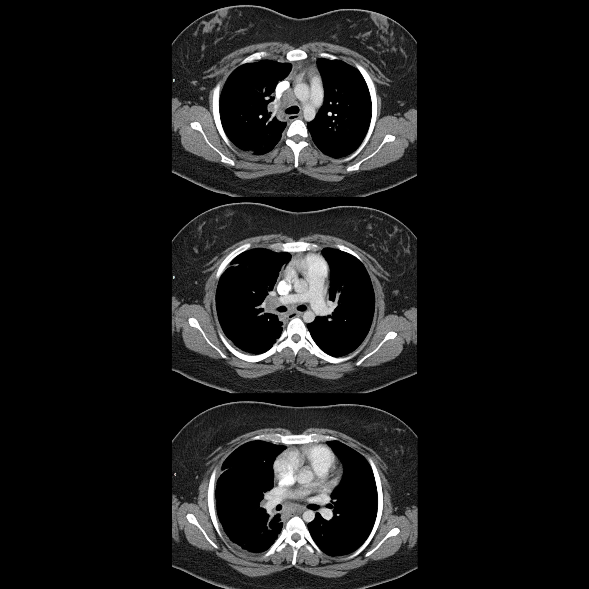 Pediatric Histoplasmosis | Pediatric Radiology Reference Article ...