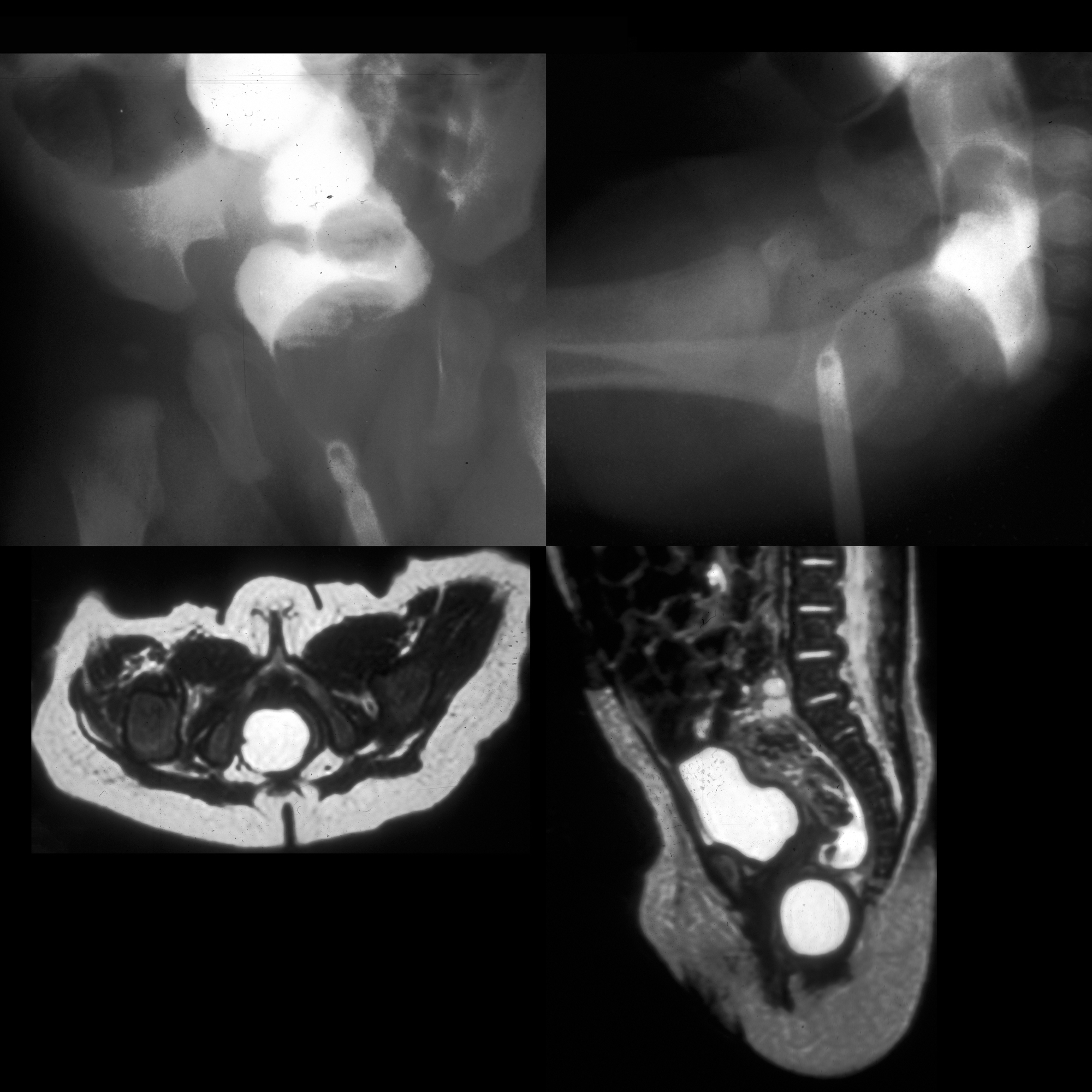 rectal-duplication-pediatric-radiology-reference-article-pediatric
