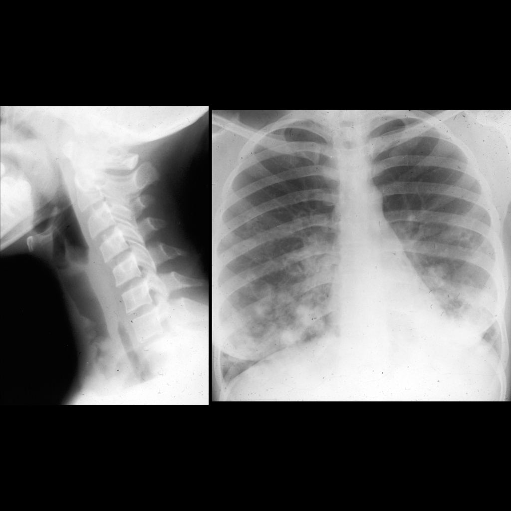 Radiograph and CXR of tracheobronchial papillomatosis