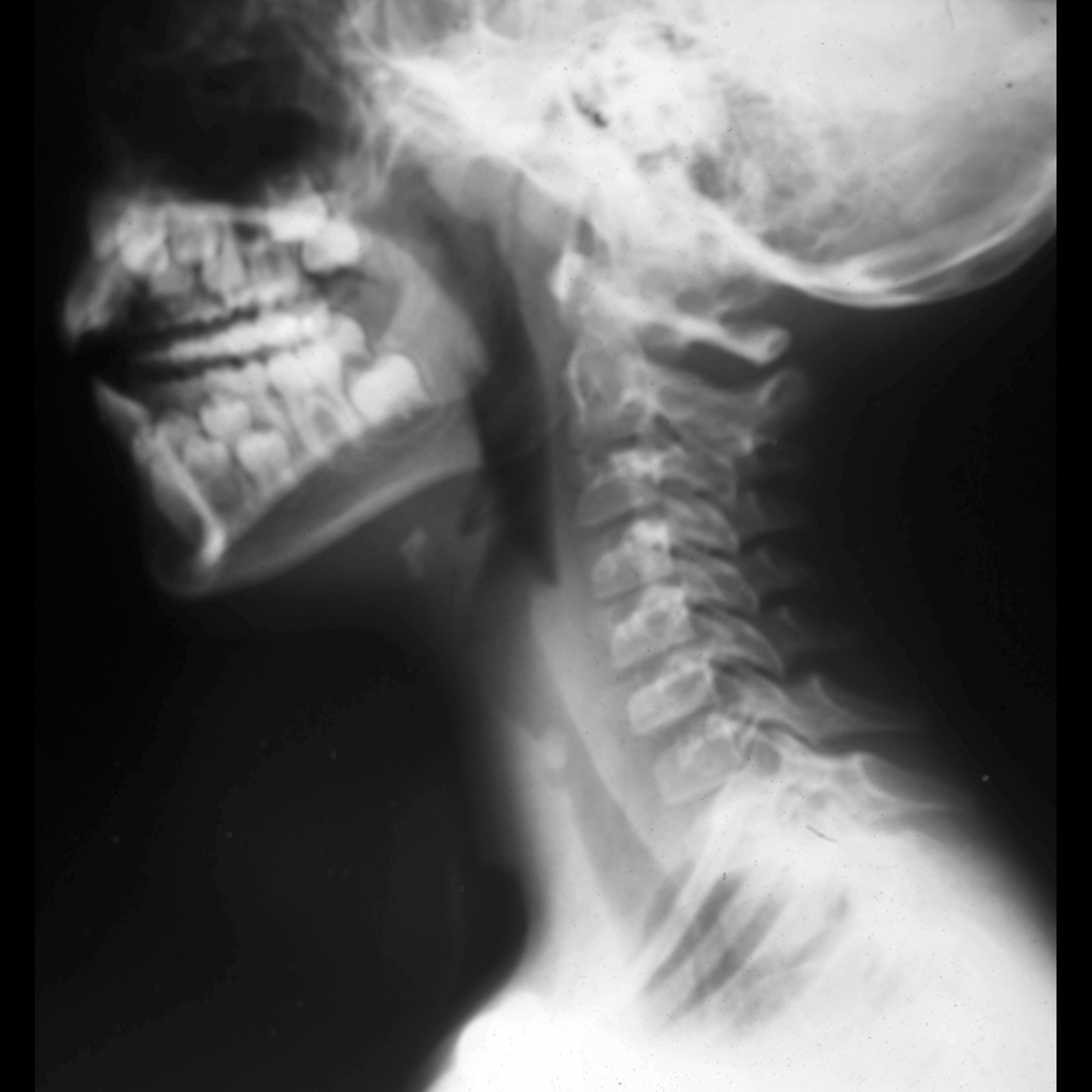 Former premature newborn with a history of longstanding endotracheal intubation who now has