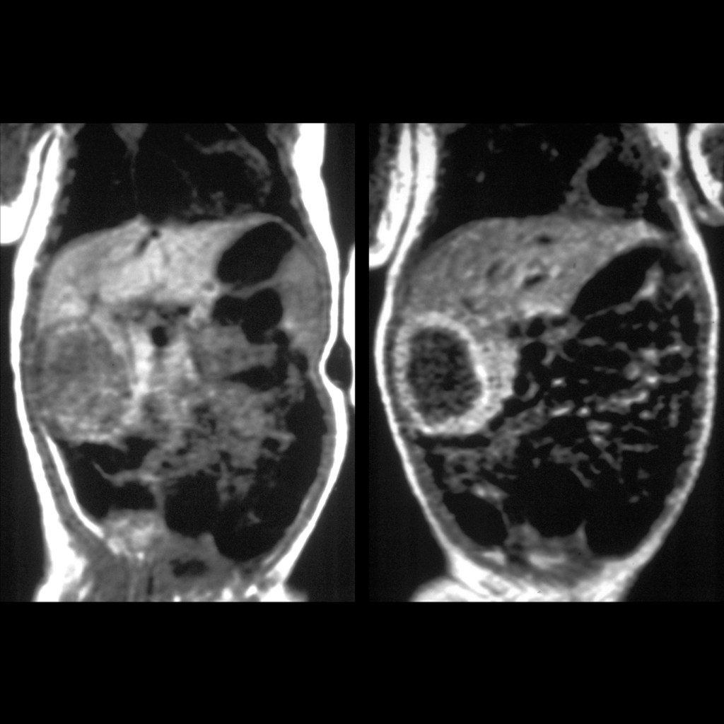 Pediatric Hepatic Hemangioma | Pediatric Radiology Reference Article ...