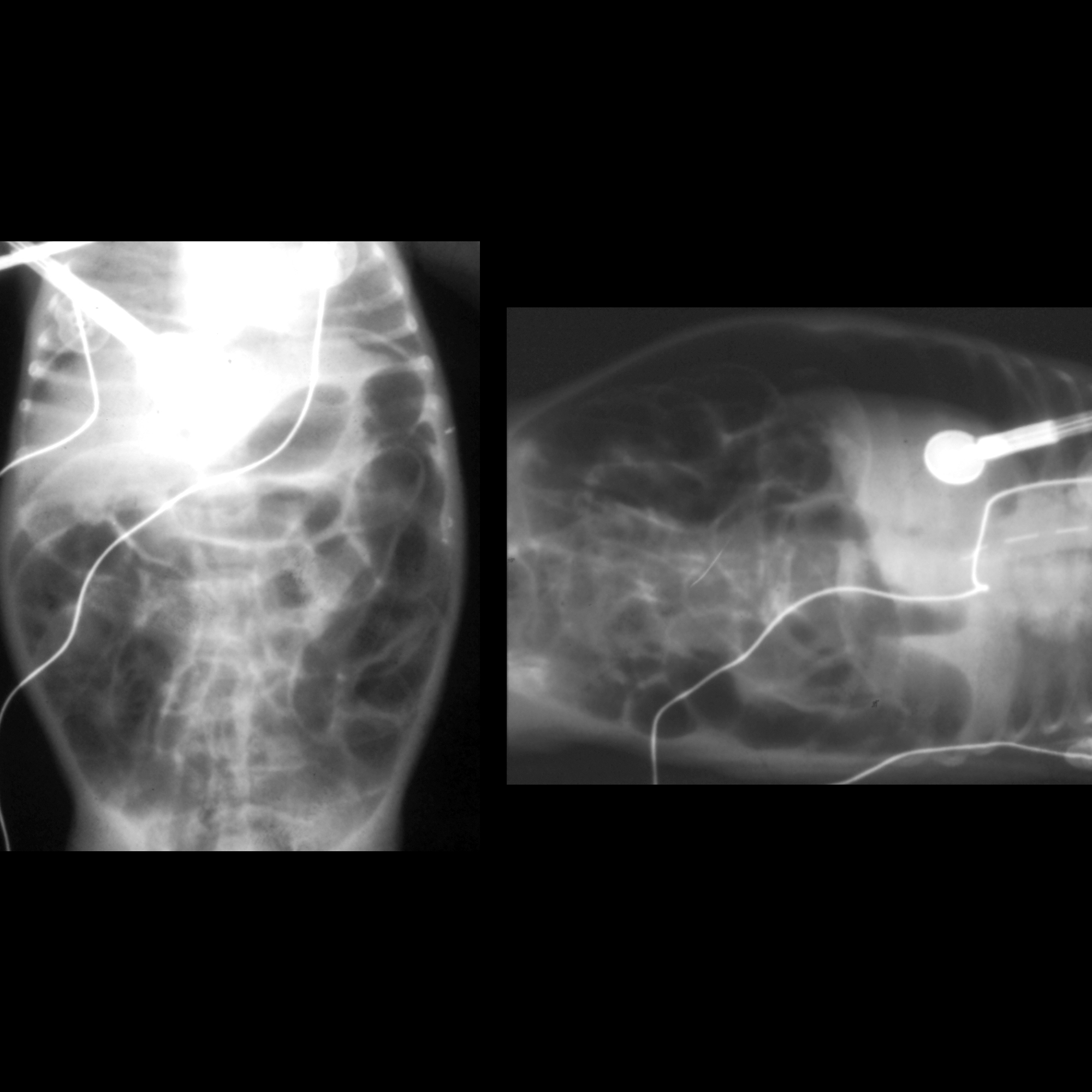 Premature newborn with abdominal distension | Pediatric Radiology Case ...