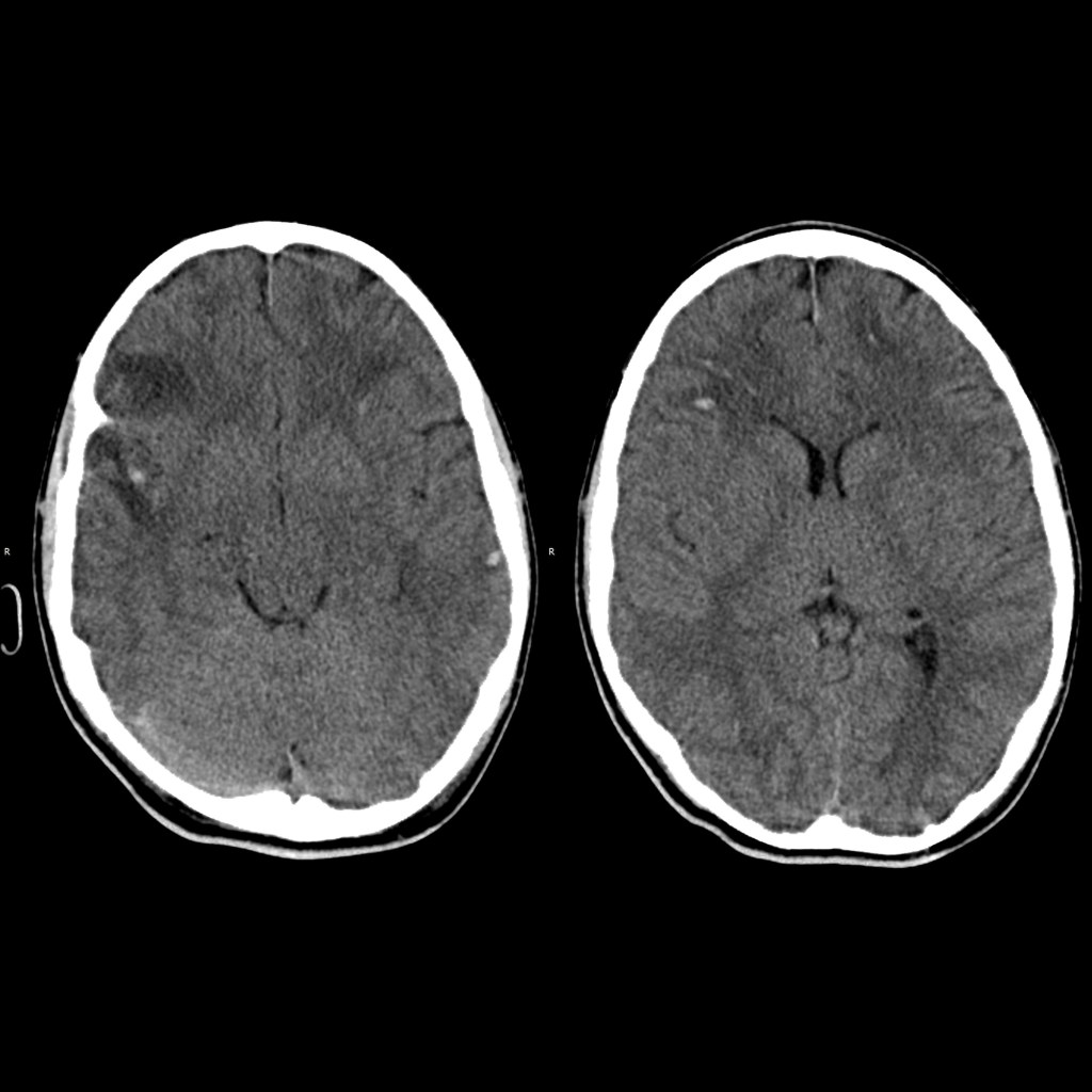 Diffuse Axonal Injury Mri Traumatic Brain Injury MRI Wikidoc