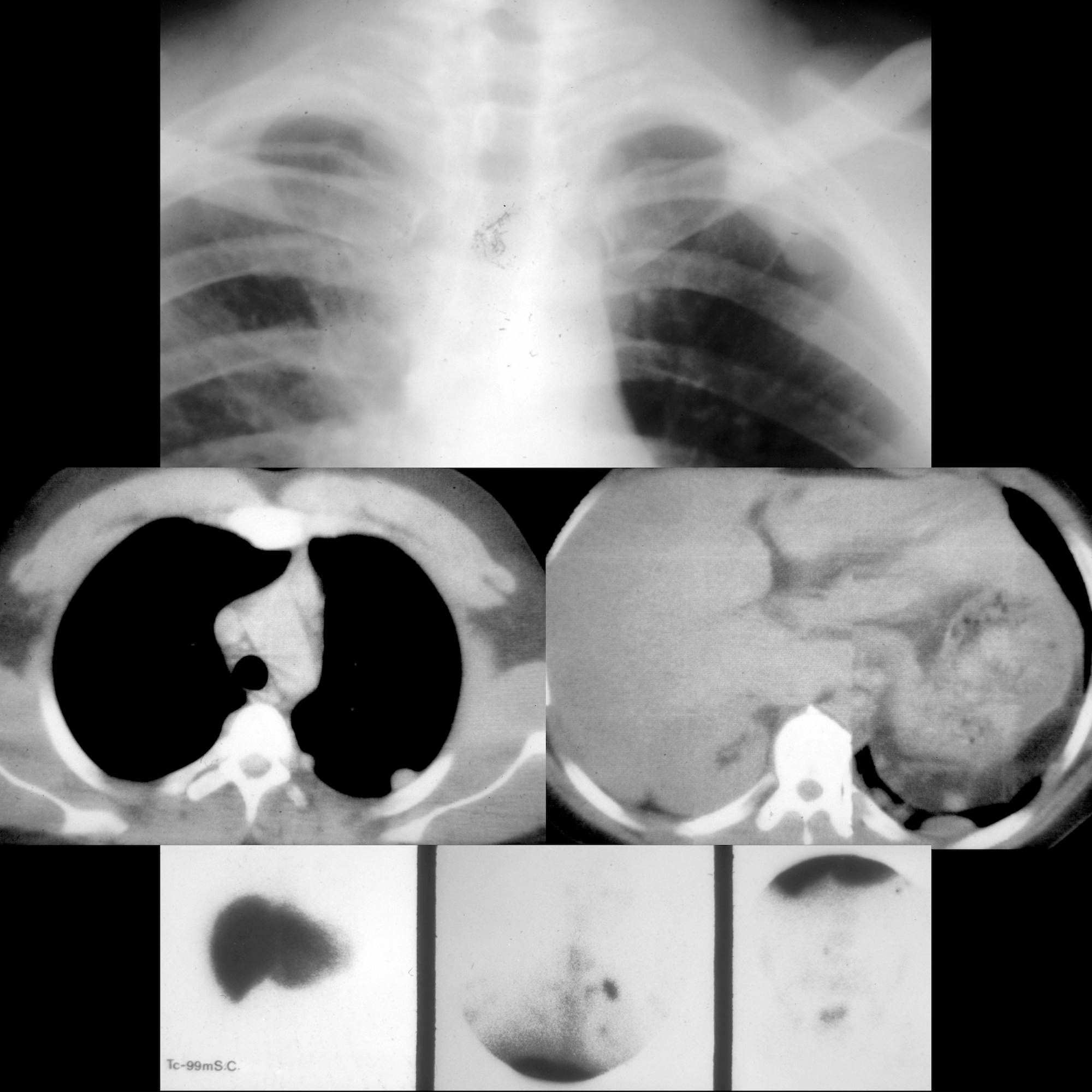 Pediatric Diaphragmatic Rupture Pediatric Radiology Reference Article