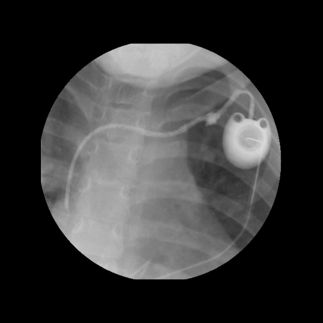 Misposition Pediatric Central Venous Catheter Malfunction / Malposition ...