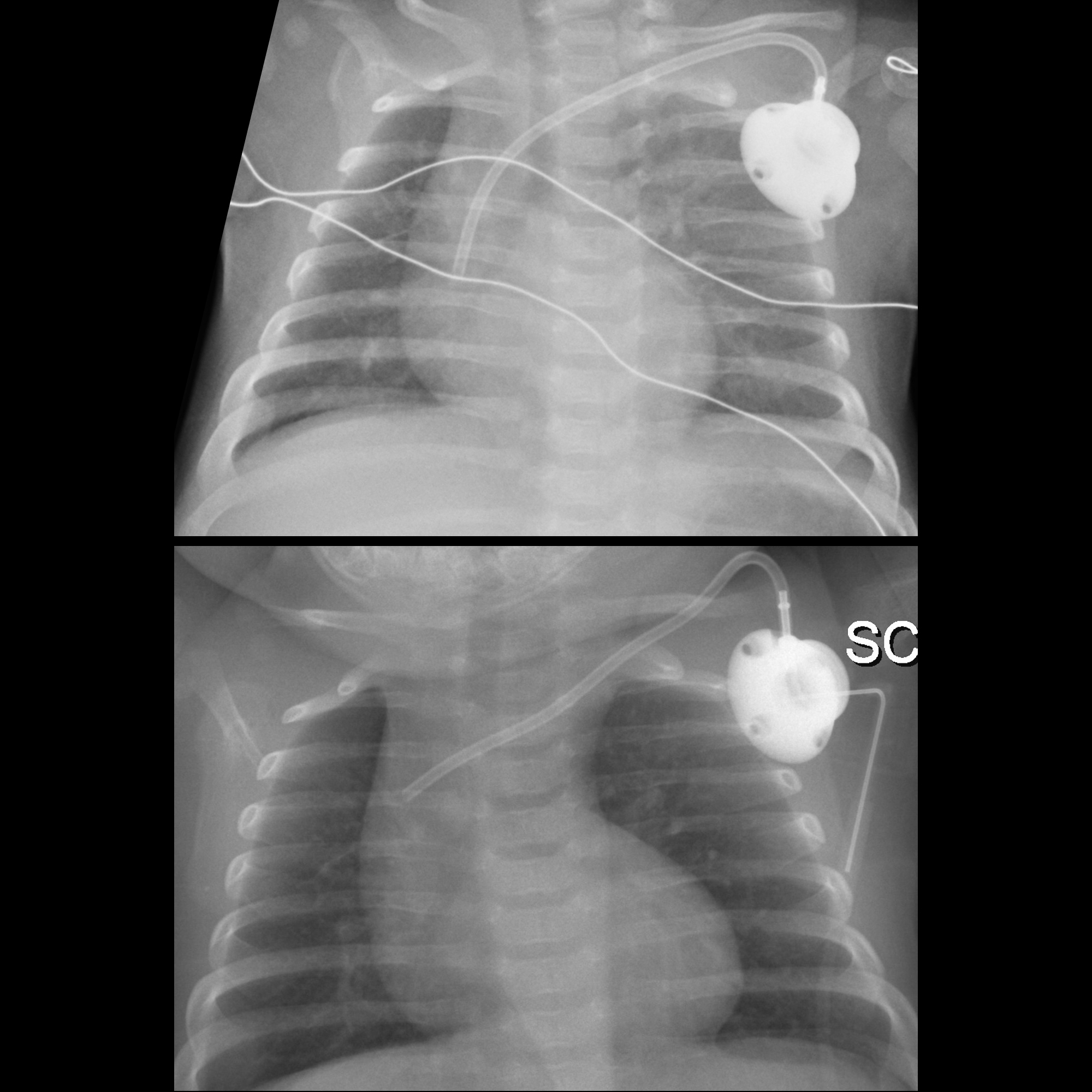 Infant with catheter that infuses but does not draw back