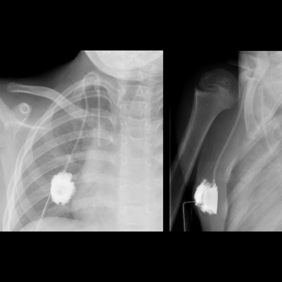 Misposition Pediatric Central Venous Catheter Malfunction / Malposition ...