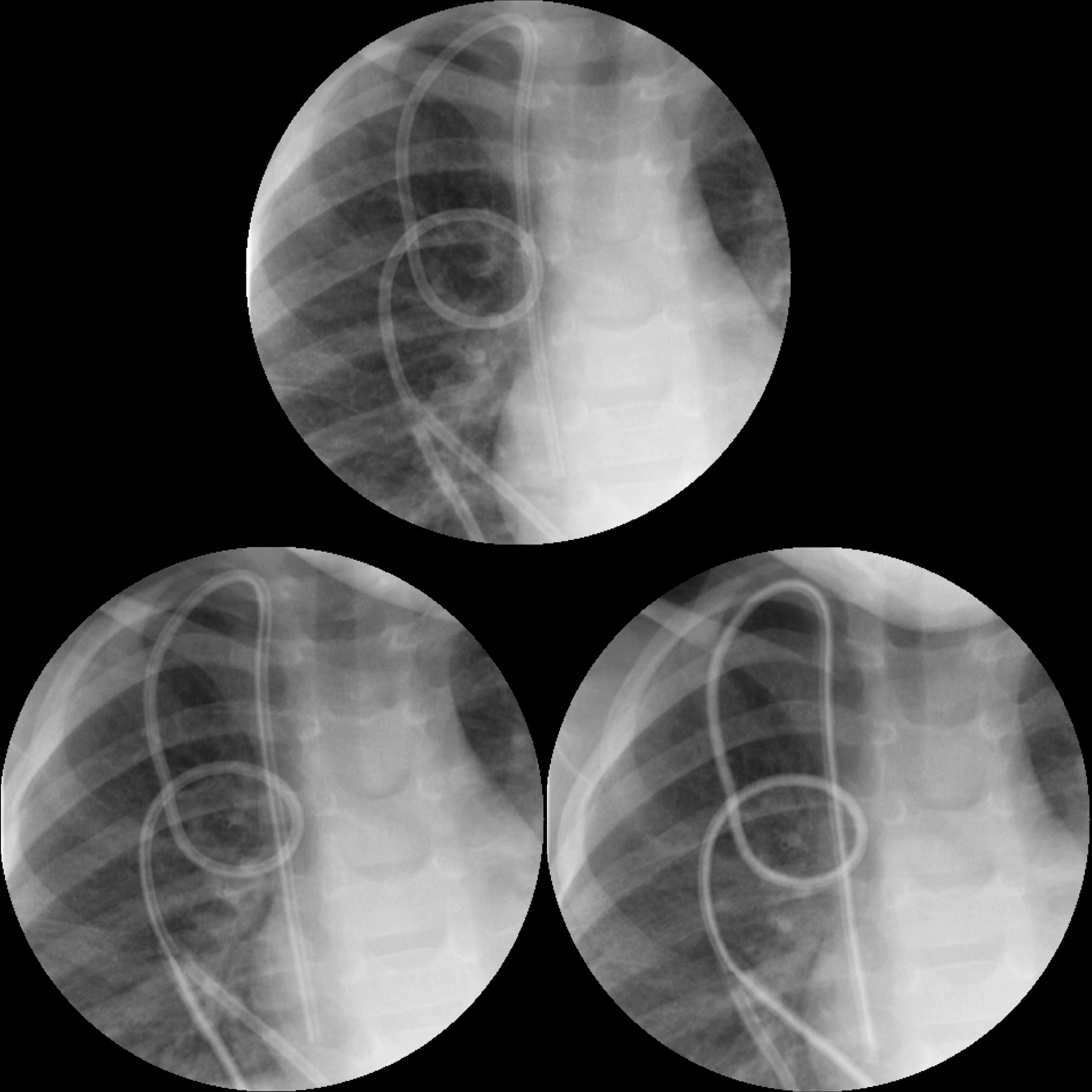 Pediatric Central Venous Catheter Malfunction / Malposition ...