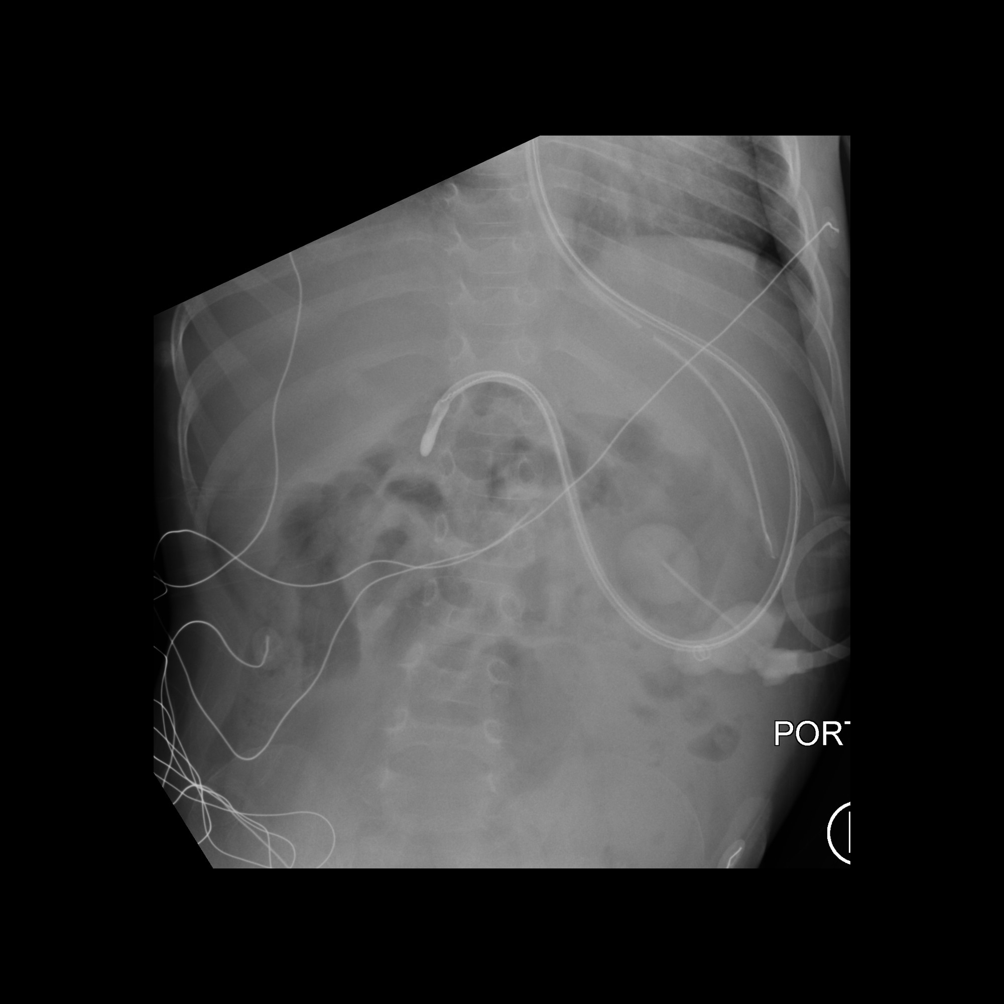 Misposition Pediatric Feeding Tube Malfunction / Malposition / Misposition ...