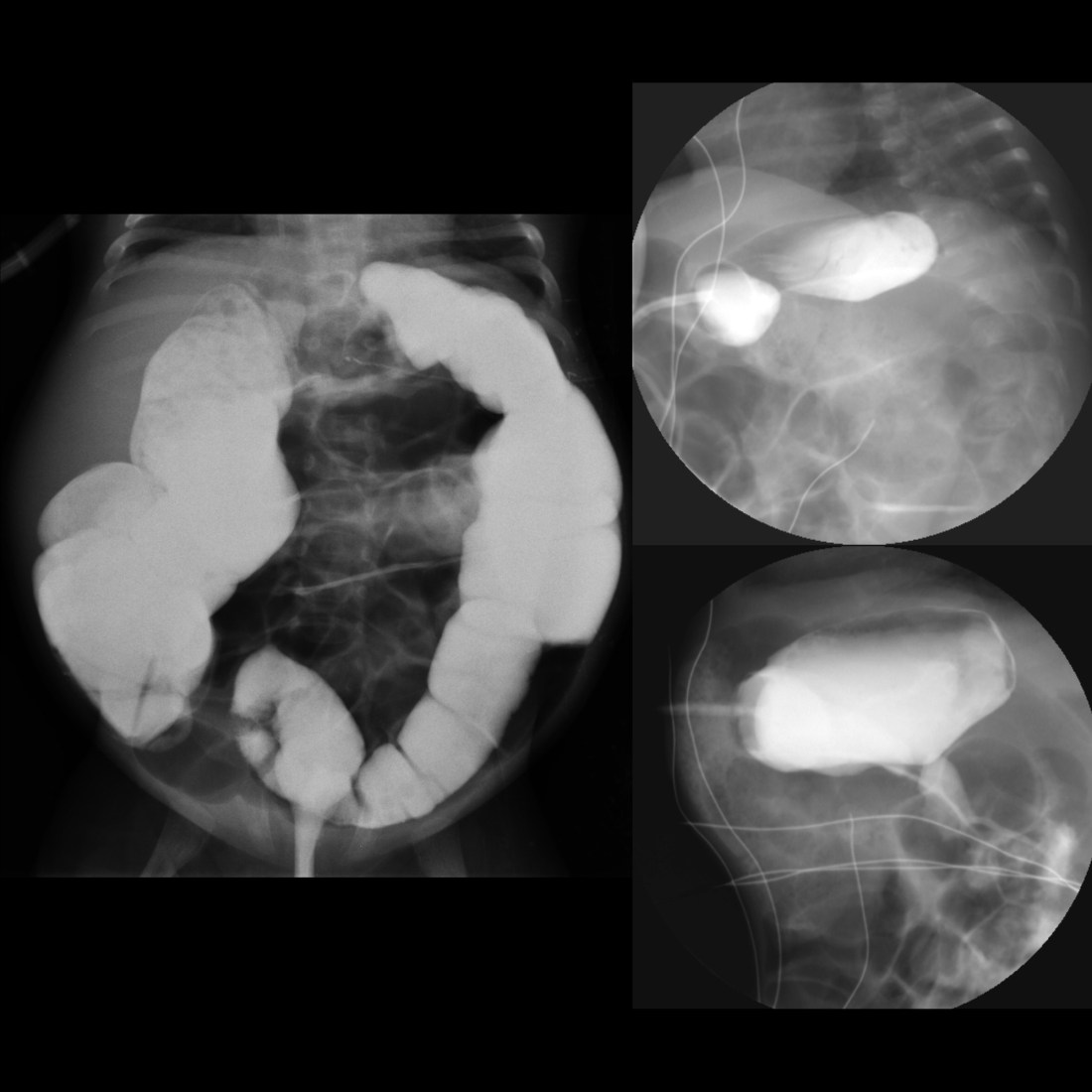 Pediatric Gastrostomy Tube Malfunction / Malposition / Misposition ...