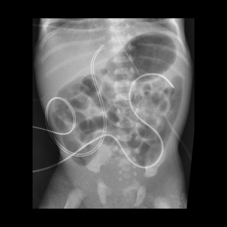 Misposition Umbilical Venous Catheter Malfunction / Malposition / Misposition ...