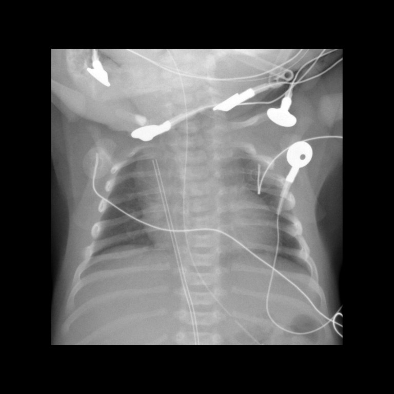 Misposition Umbilical Venous Catheter Malfunction / Malposition / Misposition ...