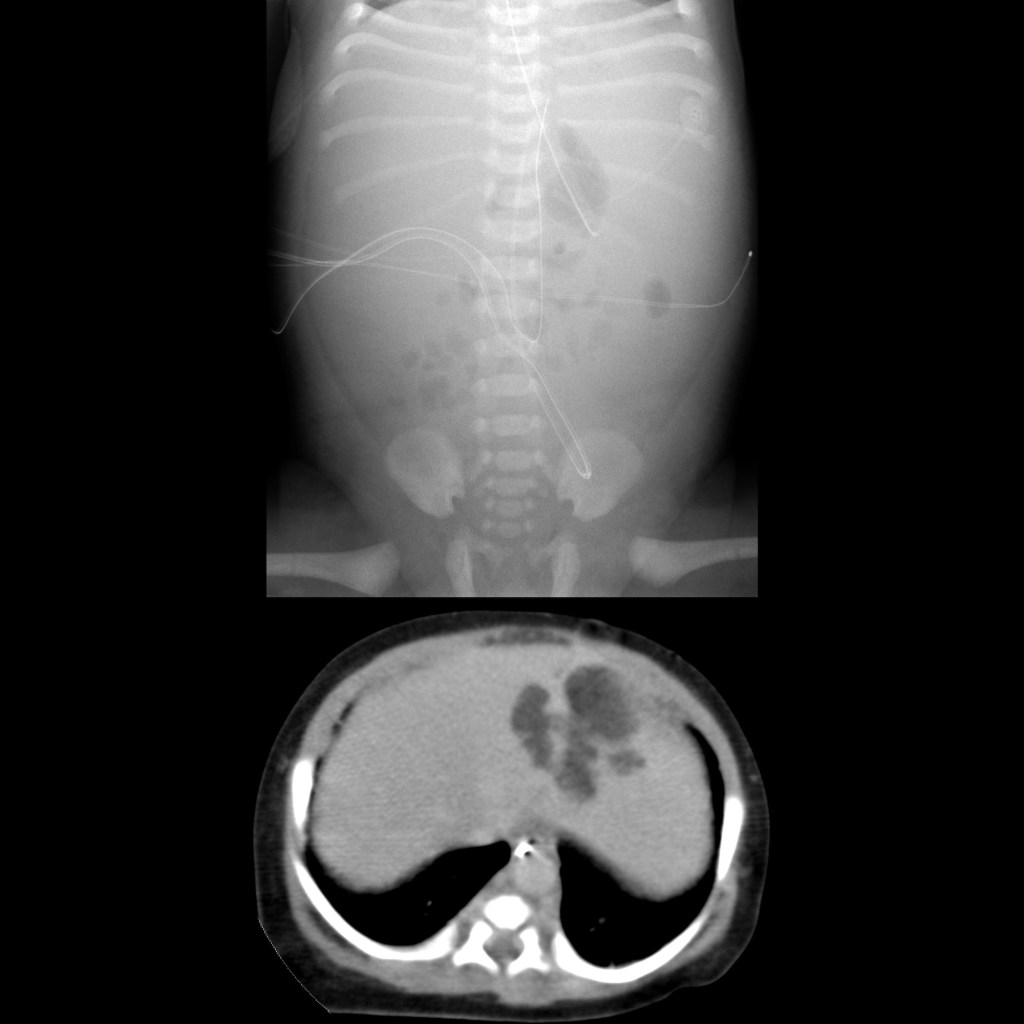 Premature newborn after umbilical venous catheter placement now with ...