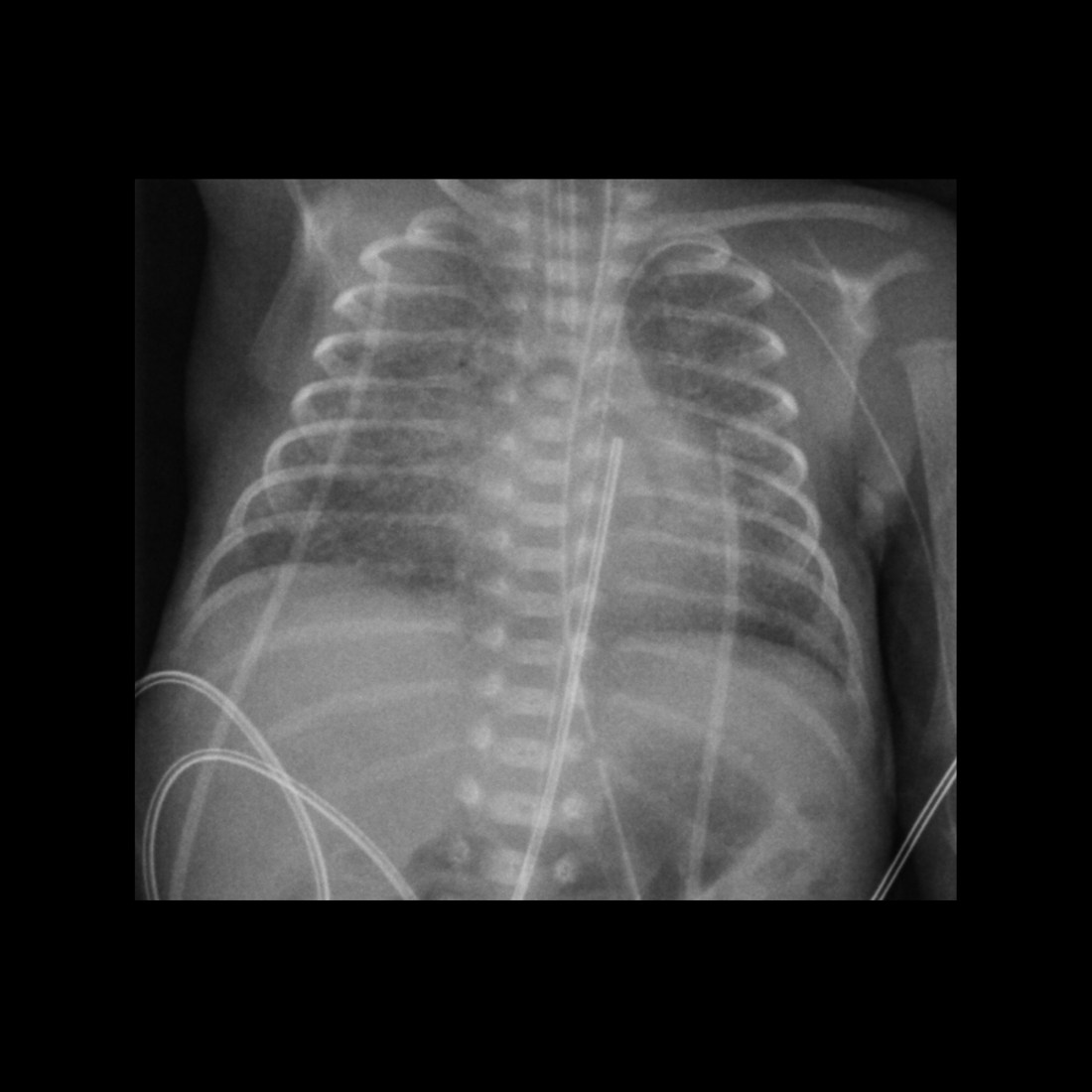 Misposition Pediatric Peripherally Inserted Central Catheter Malfunction ...
