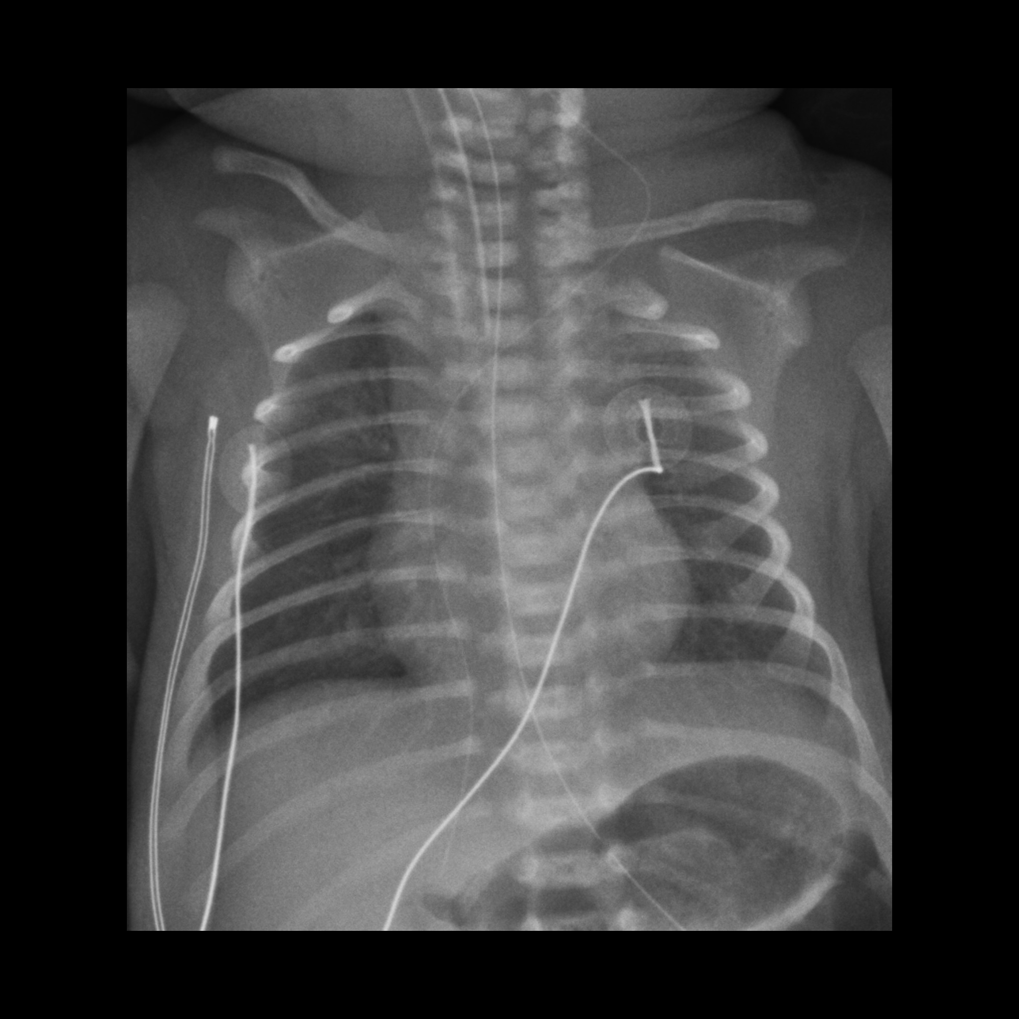 Premature infant after PICC placement | Pediatric Radiology Case ...