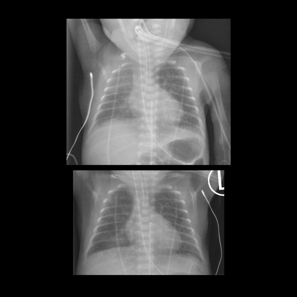 Premature newborn after PICC placement | Pediatric Radiology Case ...