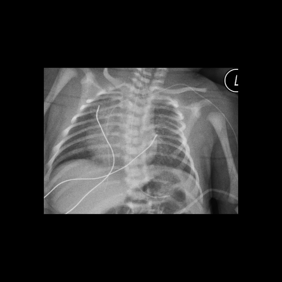 Pediatric Peripherally Inserted Central Catheter Malfunction ...