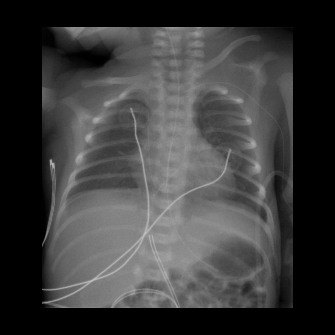 Misposition Pediatric Peripherally Inserted Central Catheter Malfunction ...