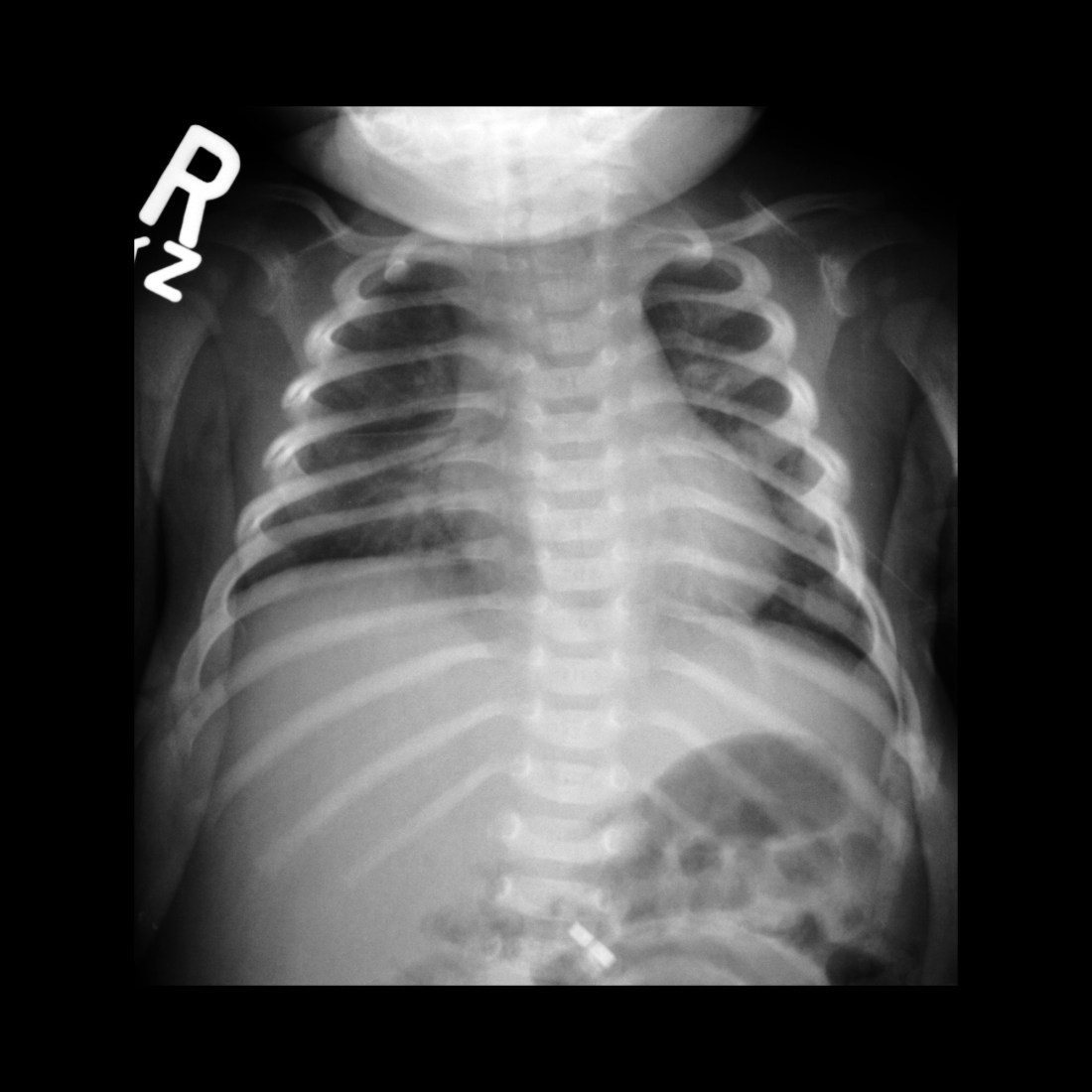Pediatric Rib Fracture | Pediatric Radiology Reference Article ...