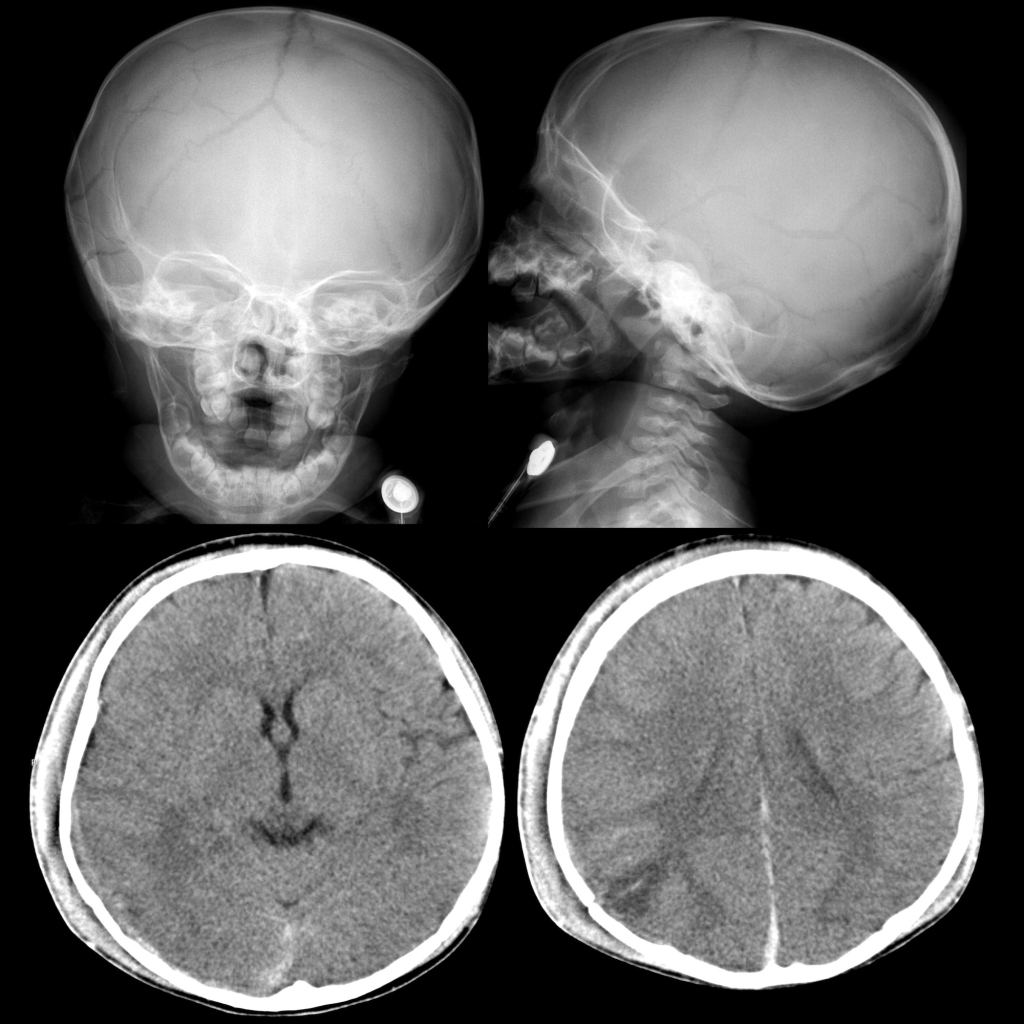 Radiograph of stellate skull fracture and CT of acute subdural hematoma due to accidental trauma