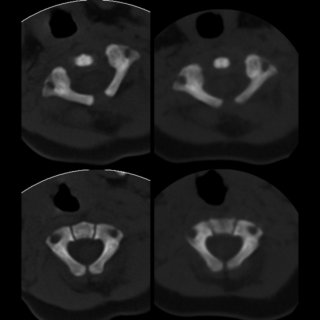 Pediatric Atlanto Axial Rotatory Subluxation | Pediatric Radiology ...