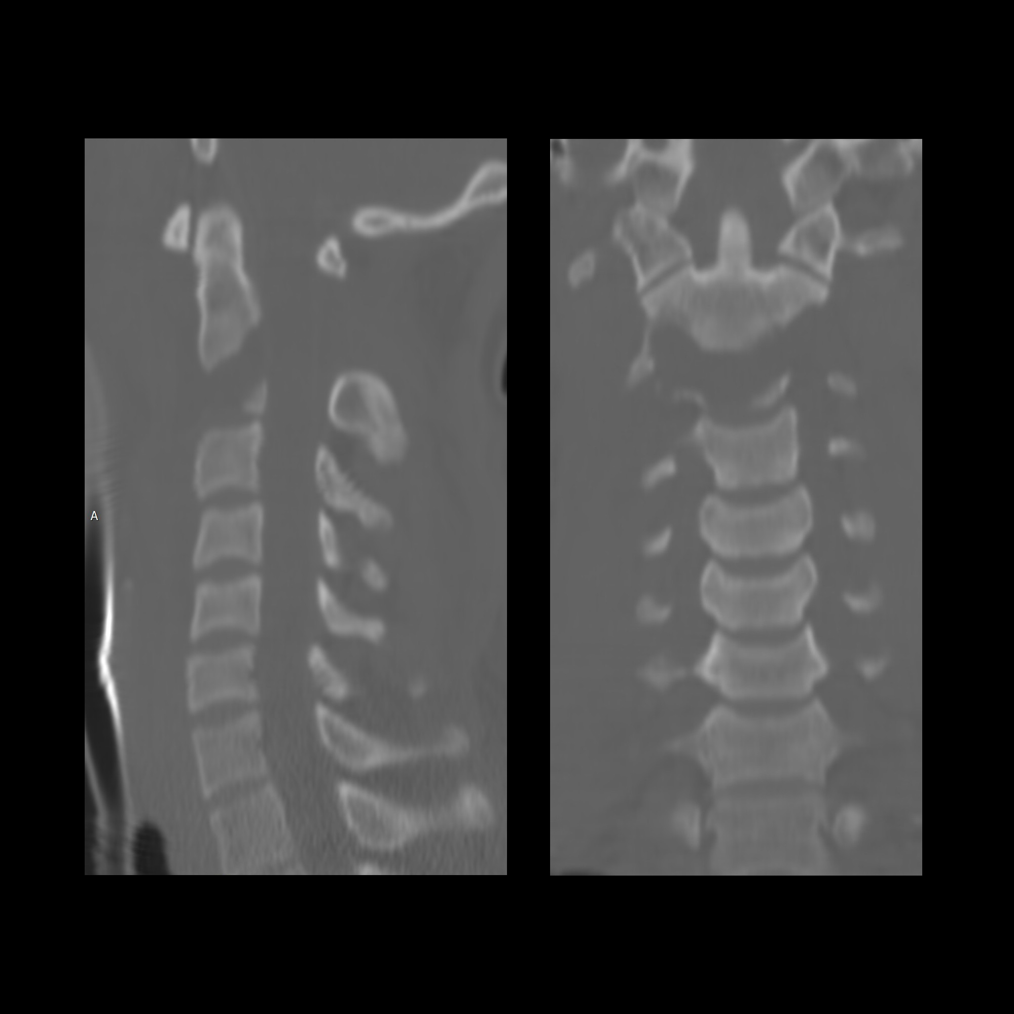 FractureCervicalSpine04MDC2FractureDistractionPreVertebralSwellingMVACT ...