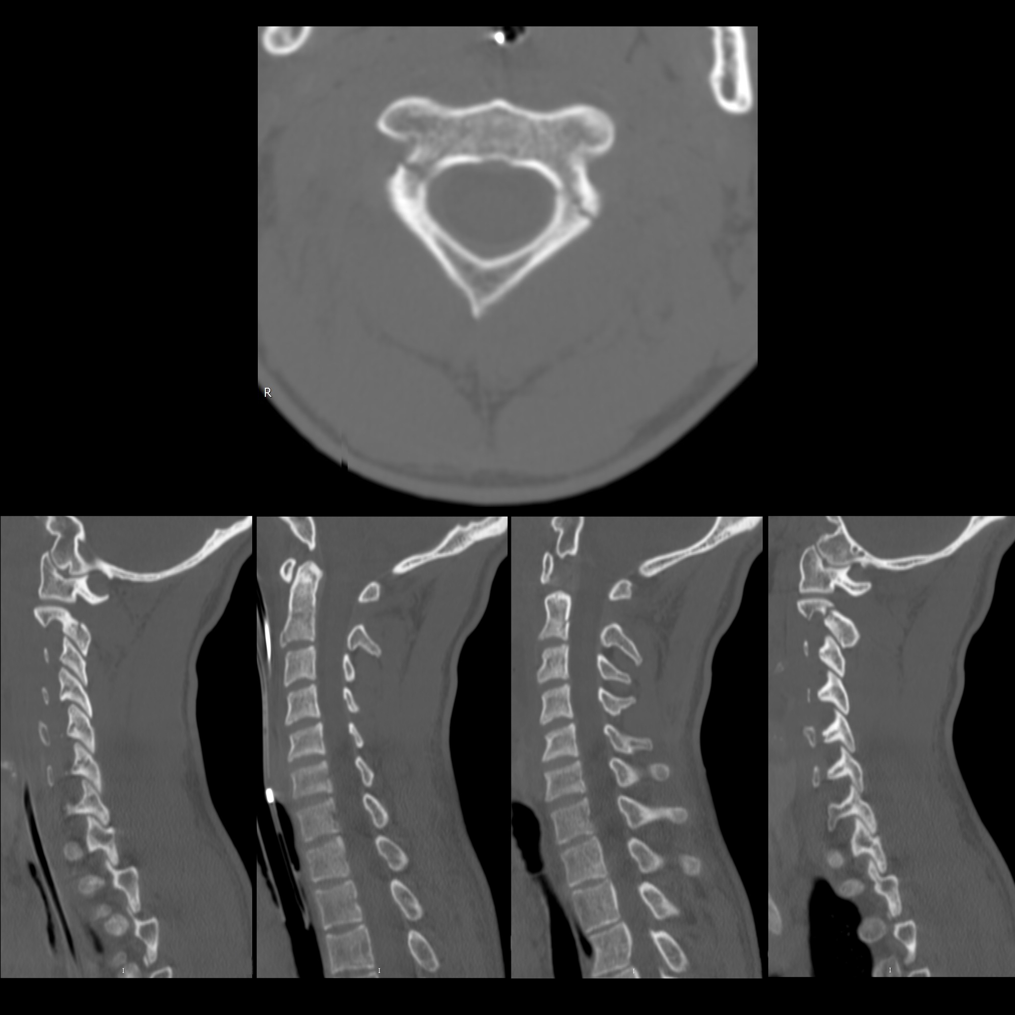 Hangman's Fracture on X-ray - X Rays Radiology Case Studies - CTisus CT  Scanning, image size:2000x2000