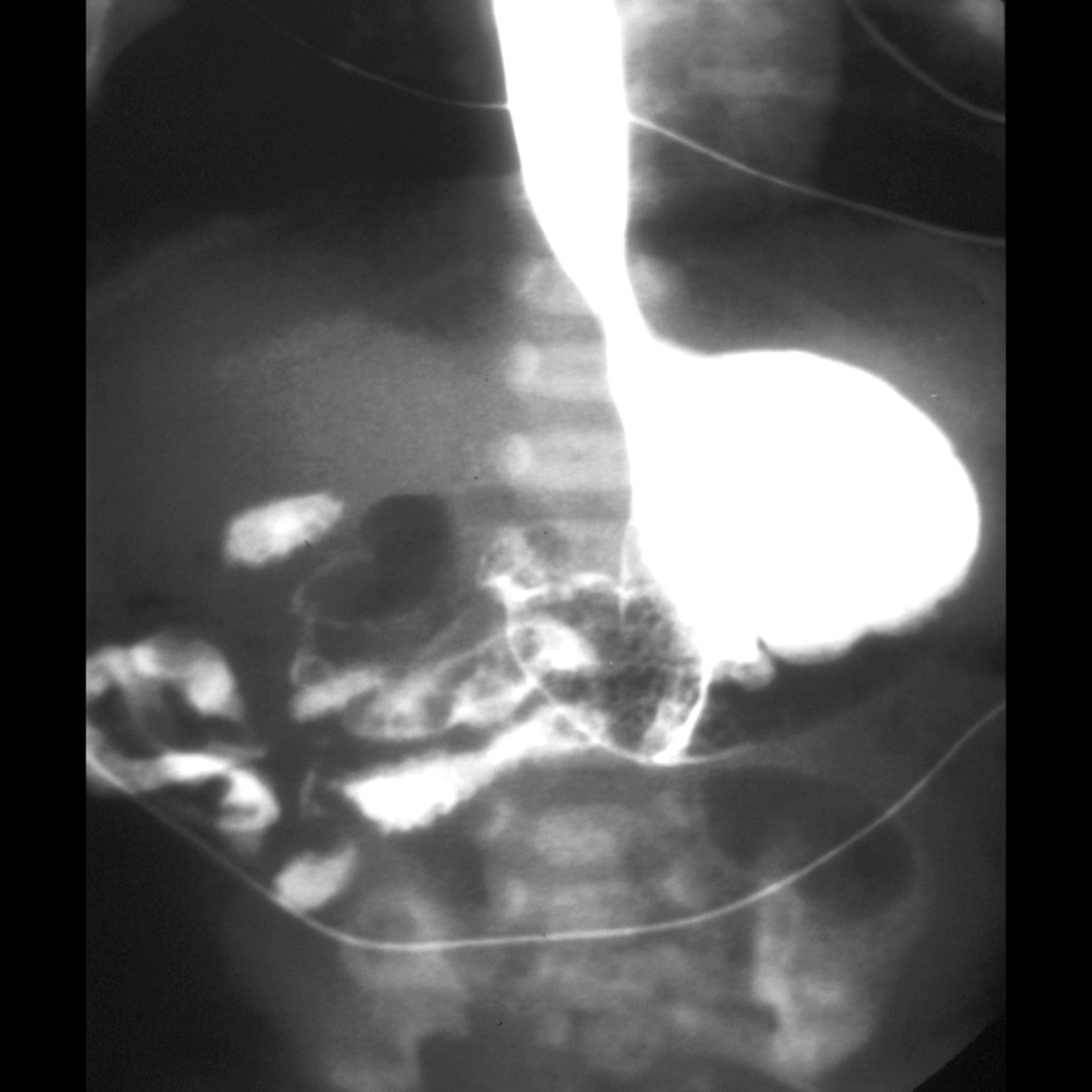 Malrotation Without Midgut Volvulus | Pediatric Radiology Reference ...