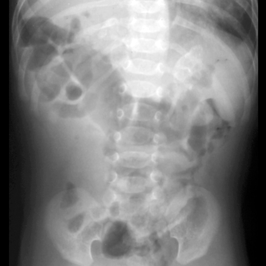 Infant with constipation | Pediatric Radiology Case | Pediatric Imaging ...