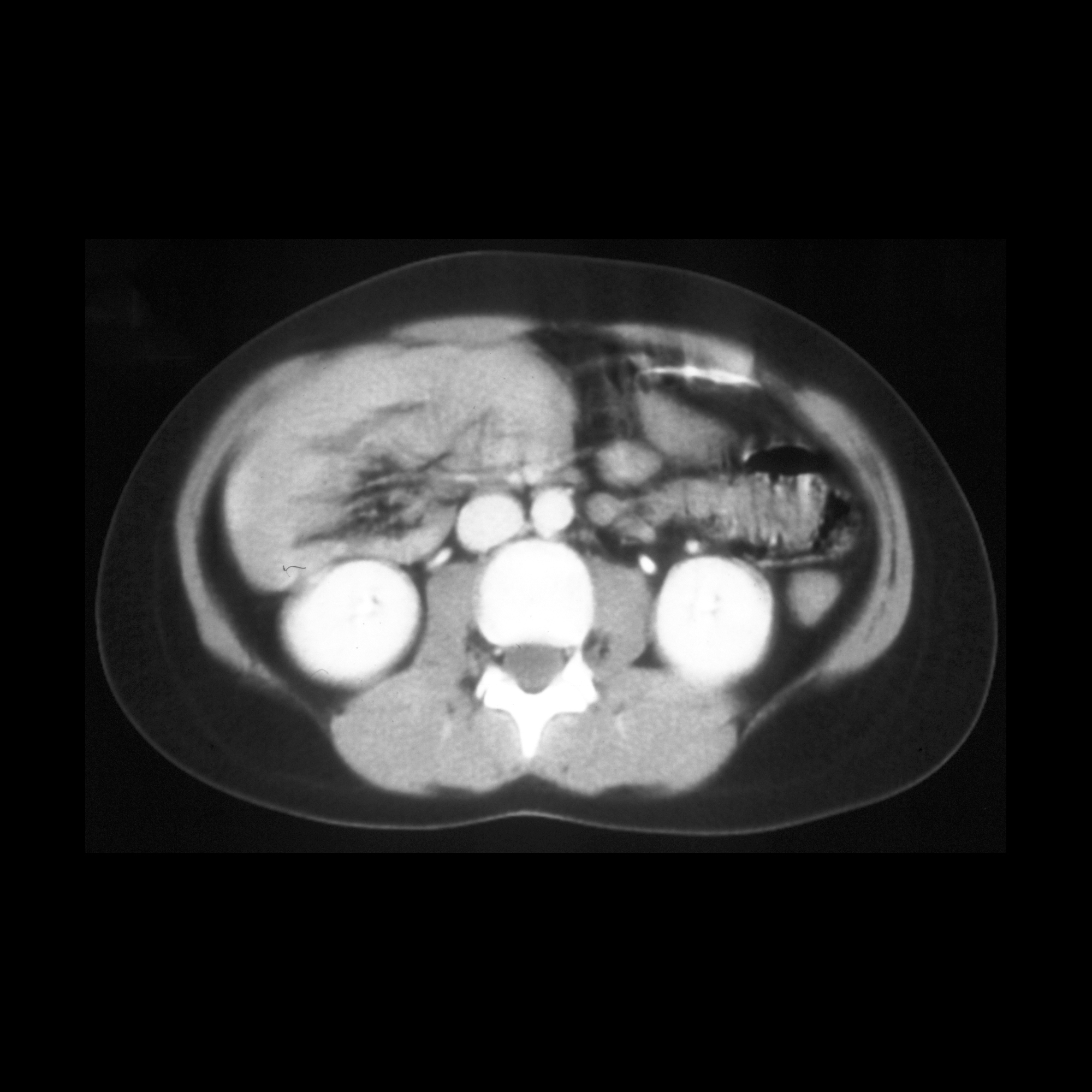 School ager who fell out of a tree and has abdominal pain | Pediatric ...