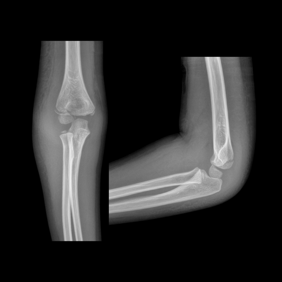 Pediatric Elbow Fracture | Pediatric Radiology Reference Article ...