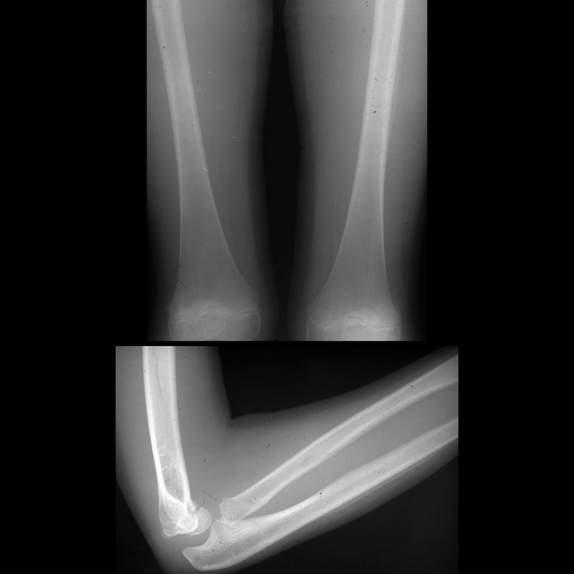 Hypervitaminosis A | Pediatric Radiology Reference Article | Pediatric