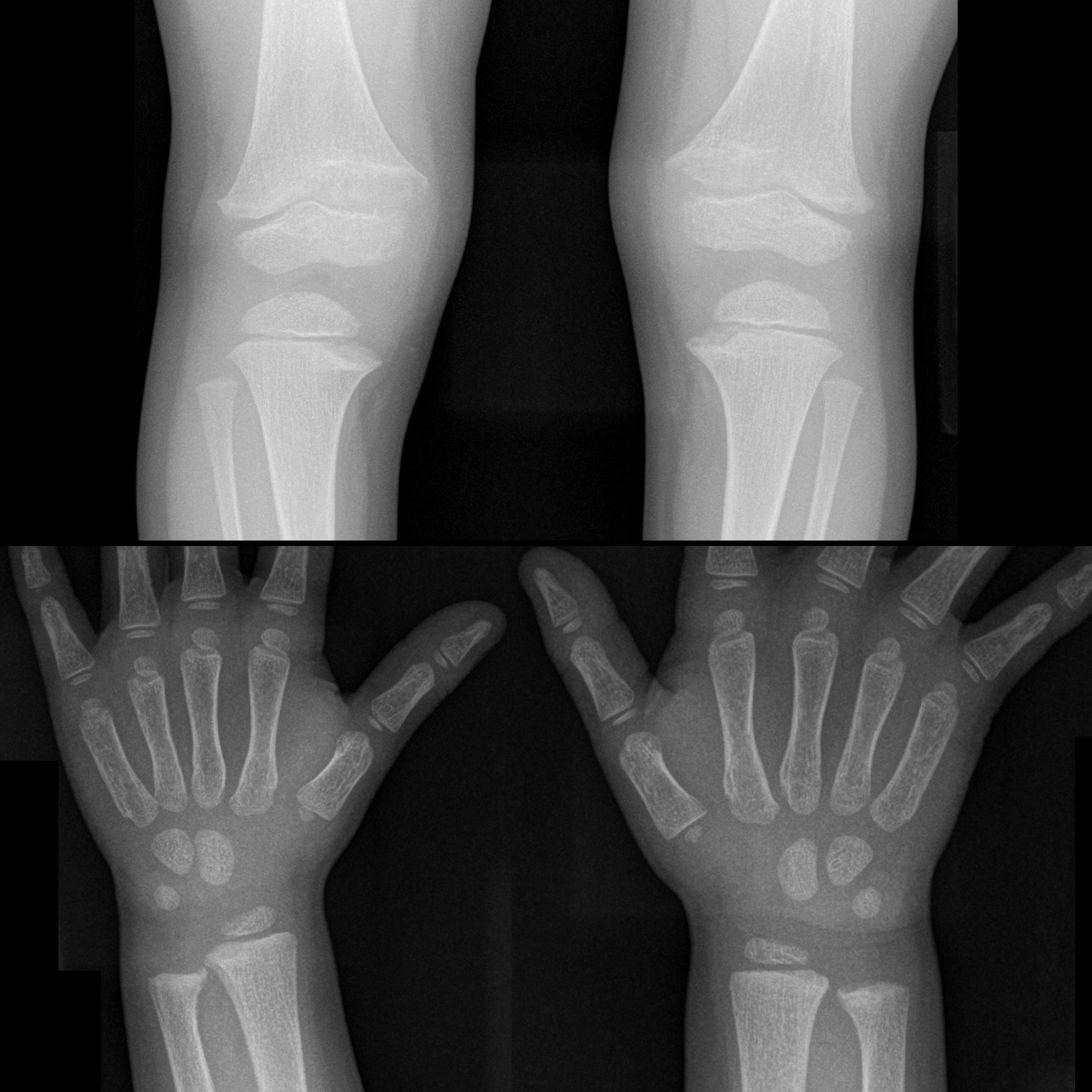 Hereditary Hypophosphatemic Rickets | Pediatric Radiology Reference ...