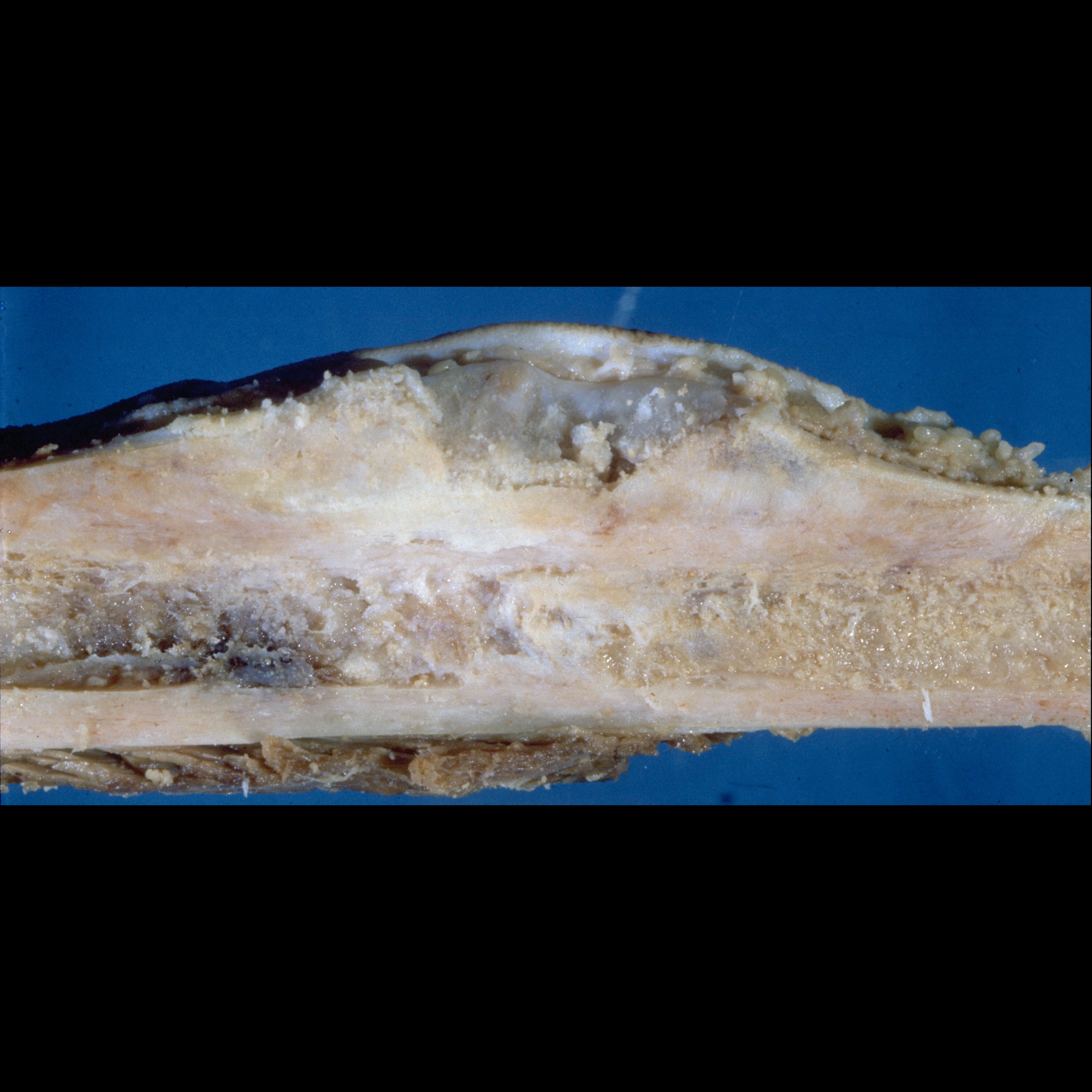 Teenager with a painful lump after bumping his shin 1 year ago ...