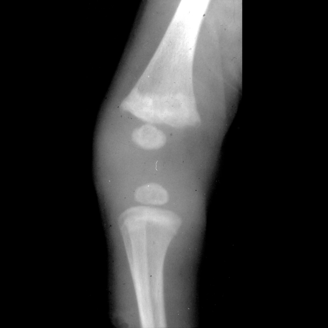 Infant with TORCH infection Pediatric Radiology Case Pediatric