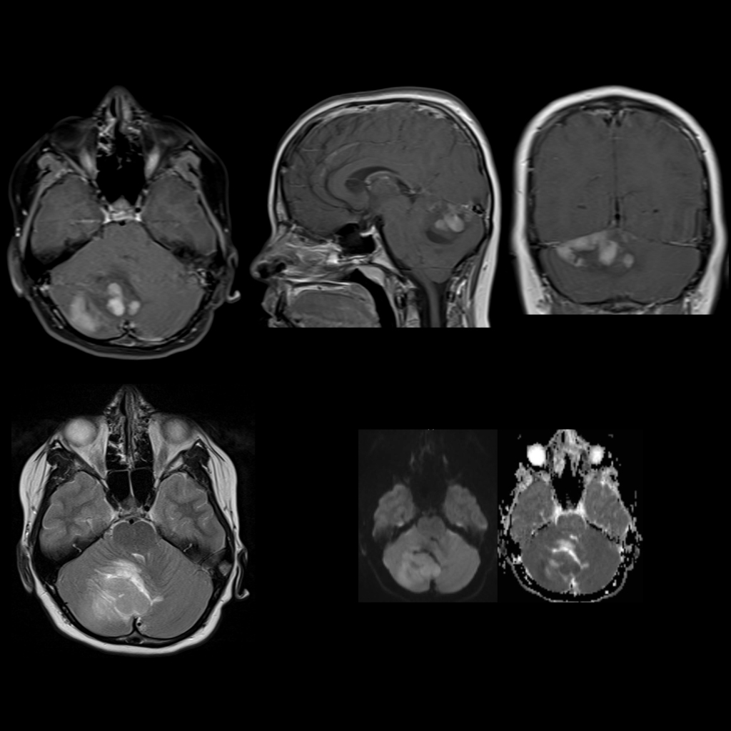 MRI of medulloblastoma in the posterior fossa
