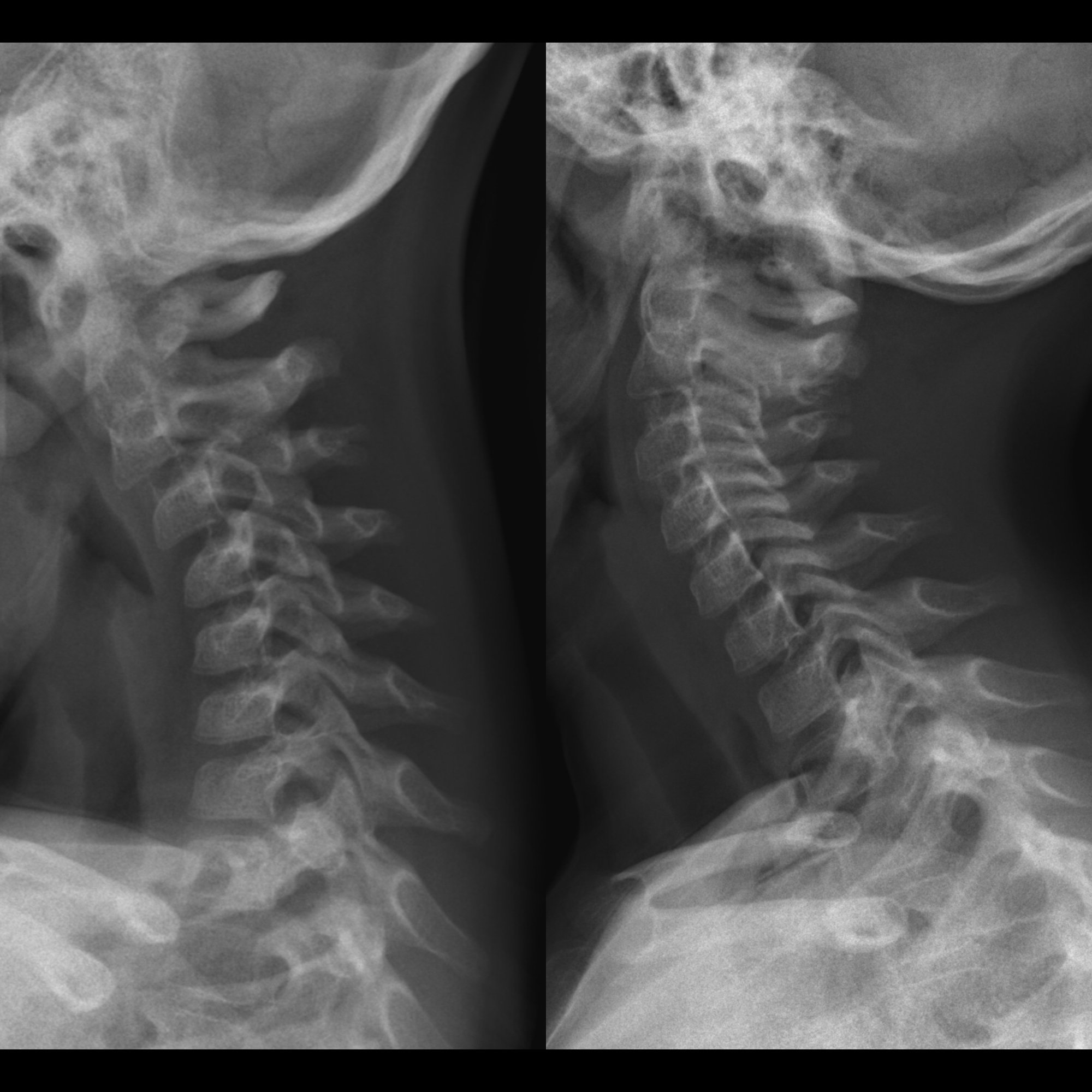 Pseudosubluxation of Cervical Spine | Pediatric Radiology