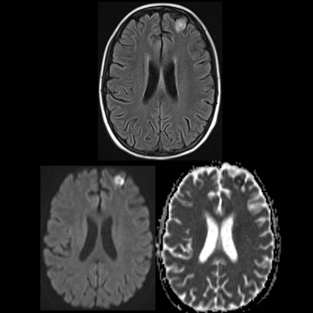 Pediatric Cryptococcosis | Pediatric Radiology Reference Article ...