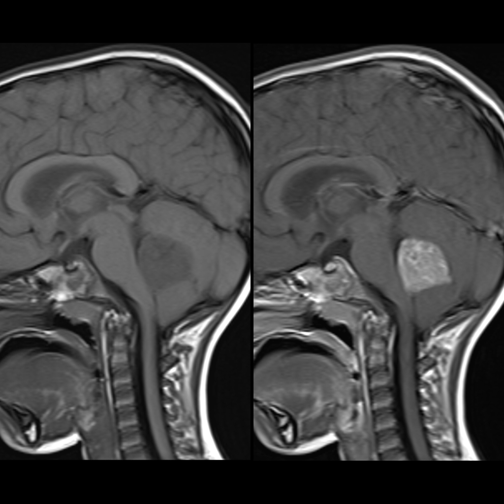 MRI of medulloblastoma