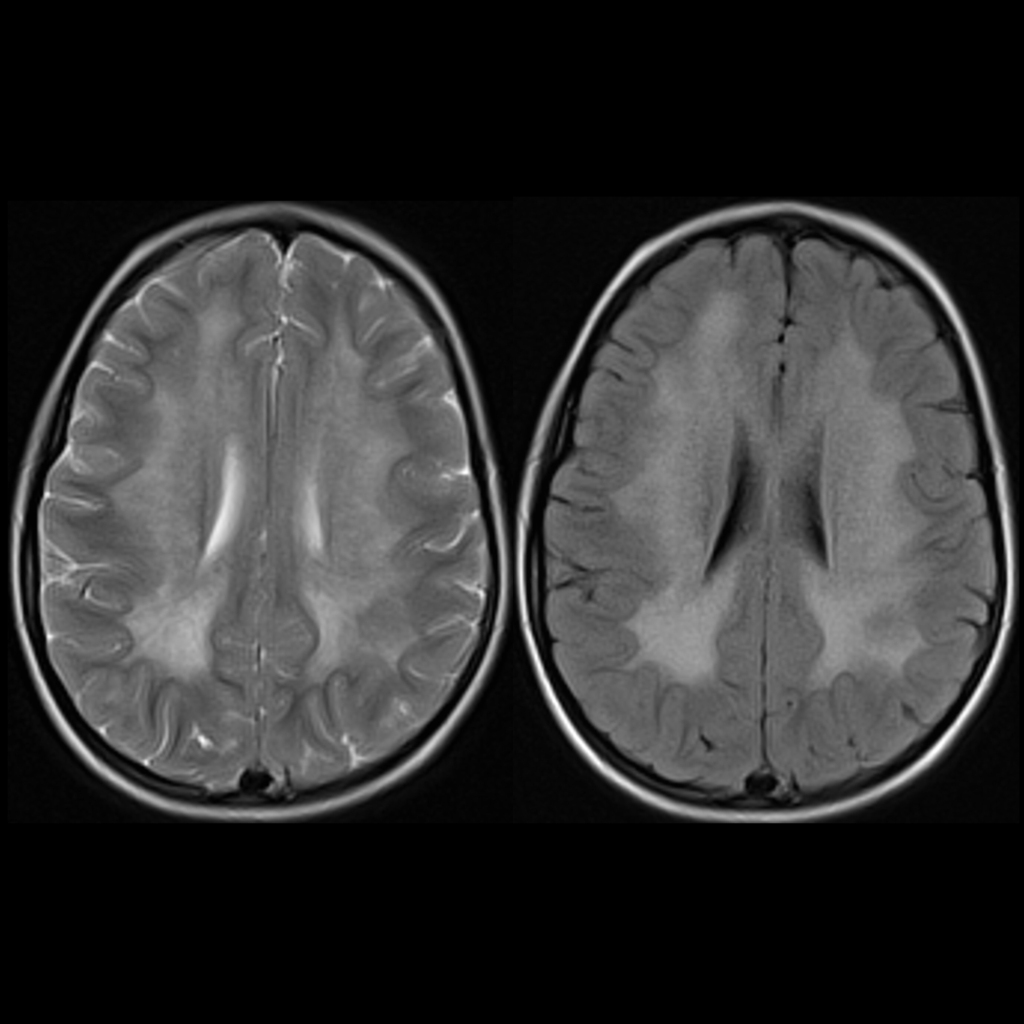 MRI of metachromatic leukodystrophy