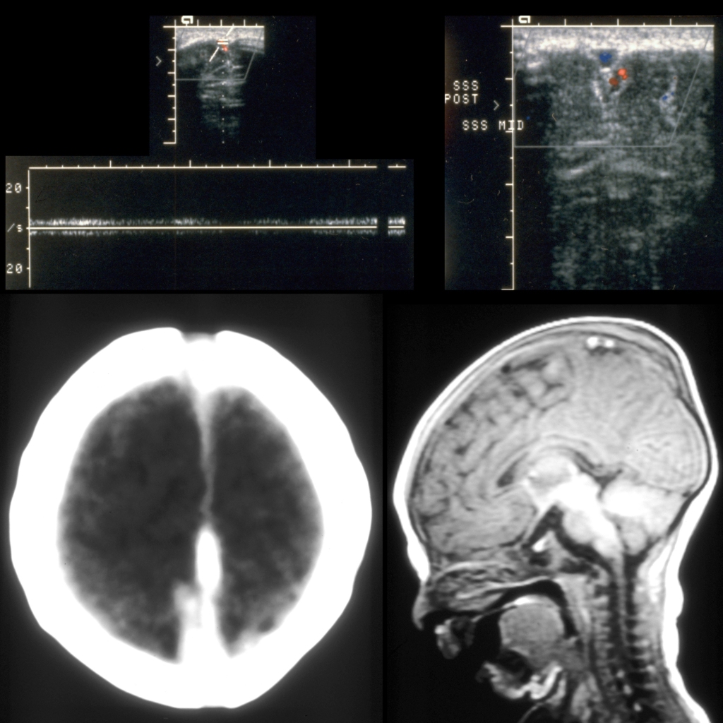 US CT MRI of superior sagittal sinus thrombosis / SSST