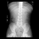 Pediatric Constipation | Pediatric Radiology Reference Article ...