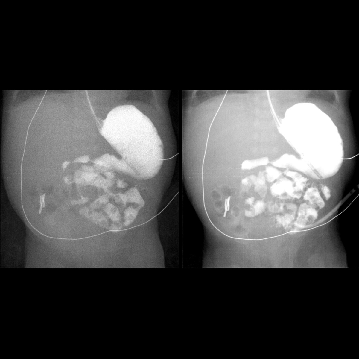 Infant status post surgery for bowel perforation Pediatric Radiology