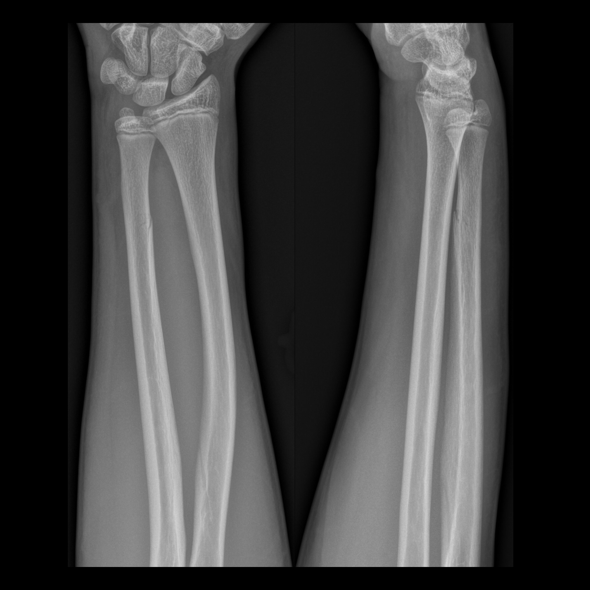 Pediatric Greenstick Fracture | Pediatric Radiology Reference Article ...