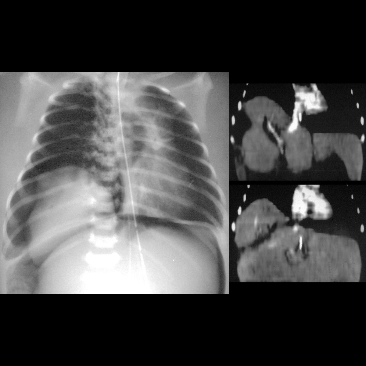 Newborn with respiratory distress and new abdominal distension ...
