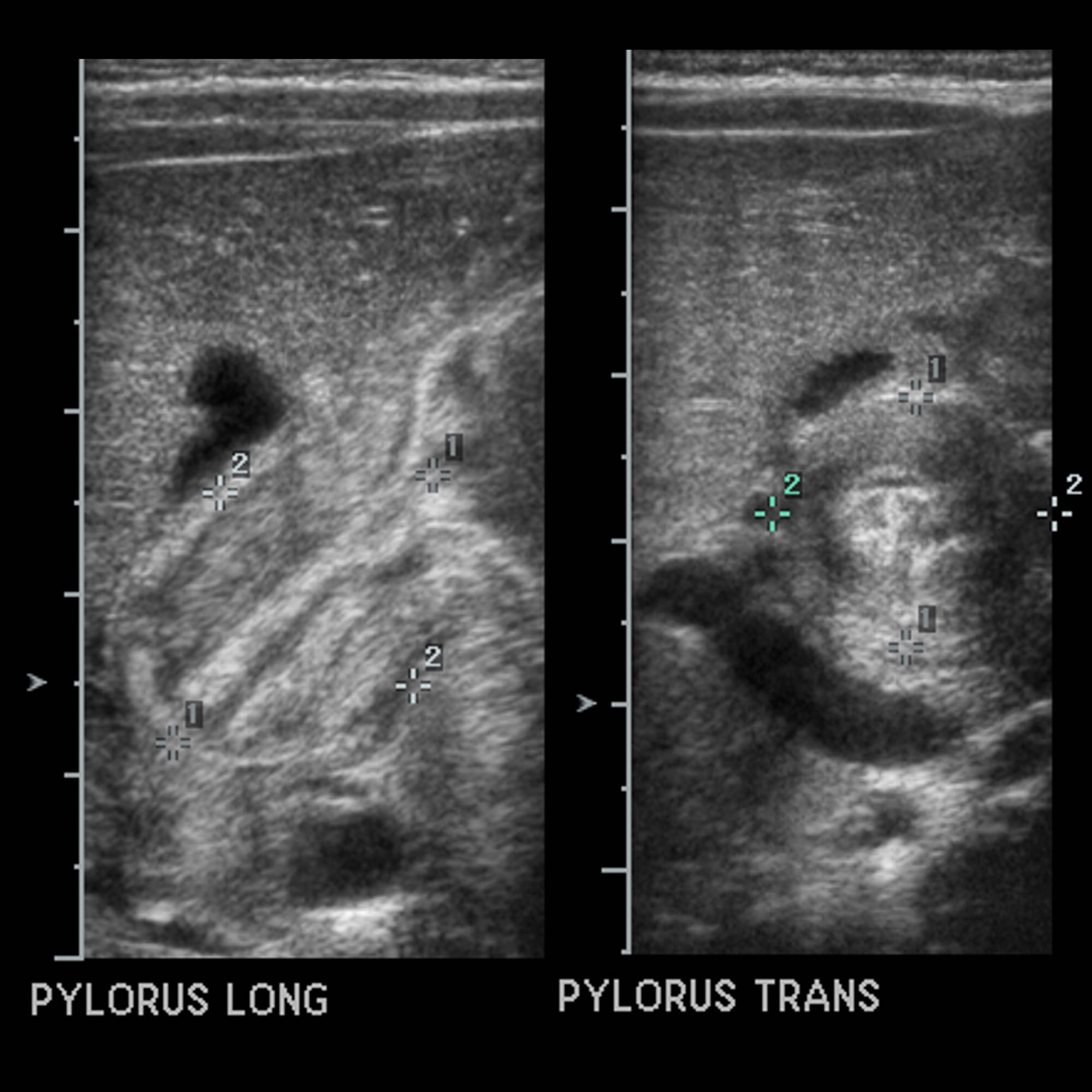 Infant with projectile vomiting Pediatric Radiology Case Pediatric