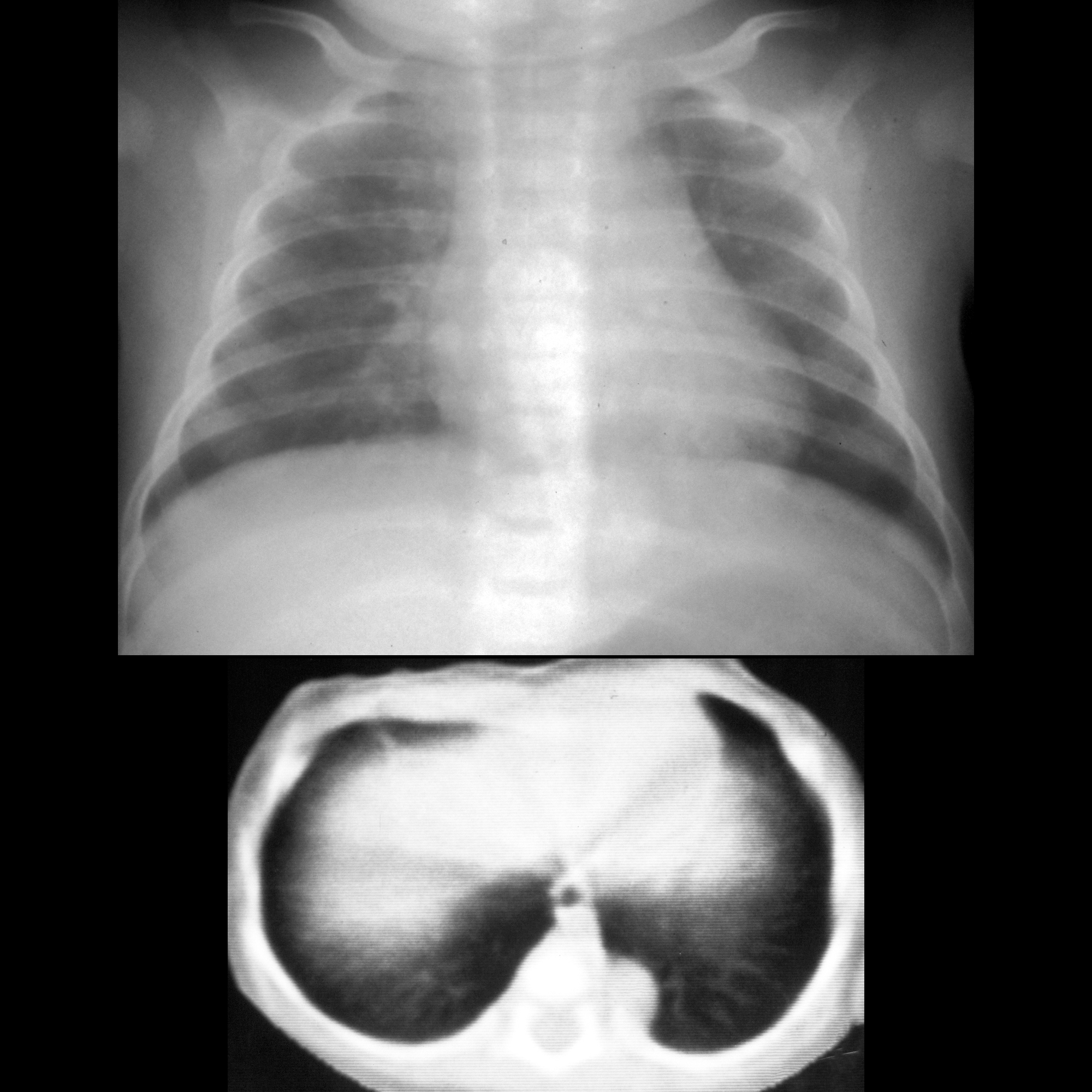 Pulmonary Sequestration | Pediatric Radiology Reference Article ...