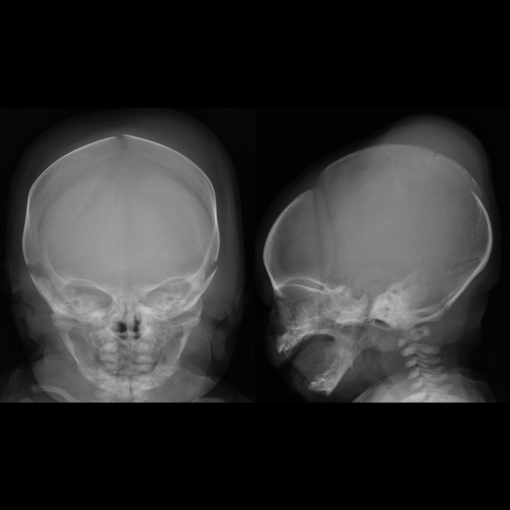 Skull radiograph of subgaleal hematoma