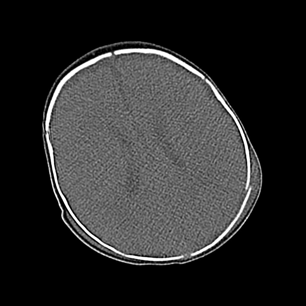 CT of subgaleal hematoma