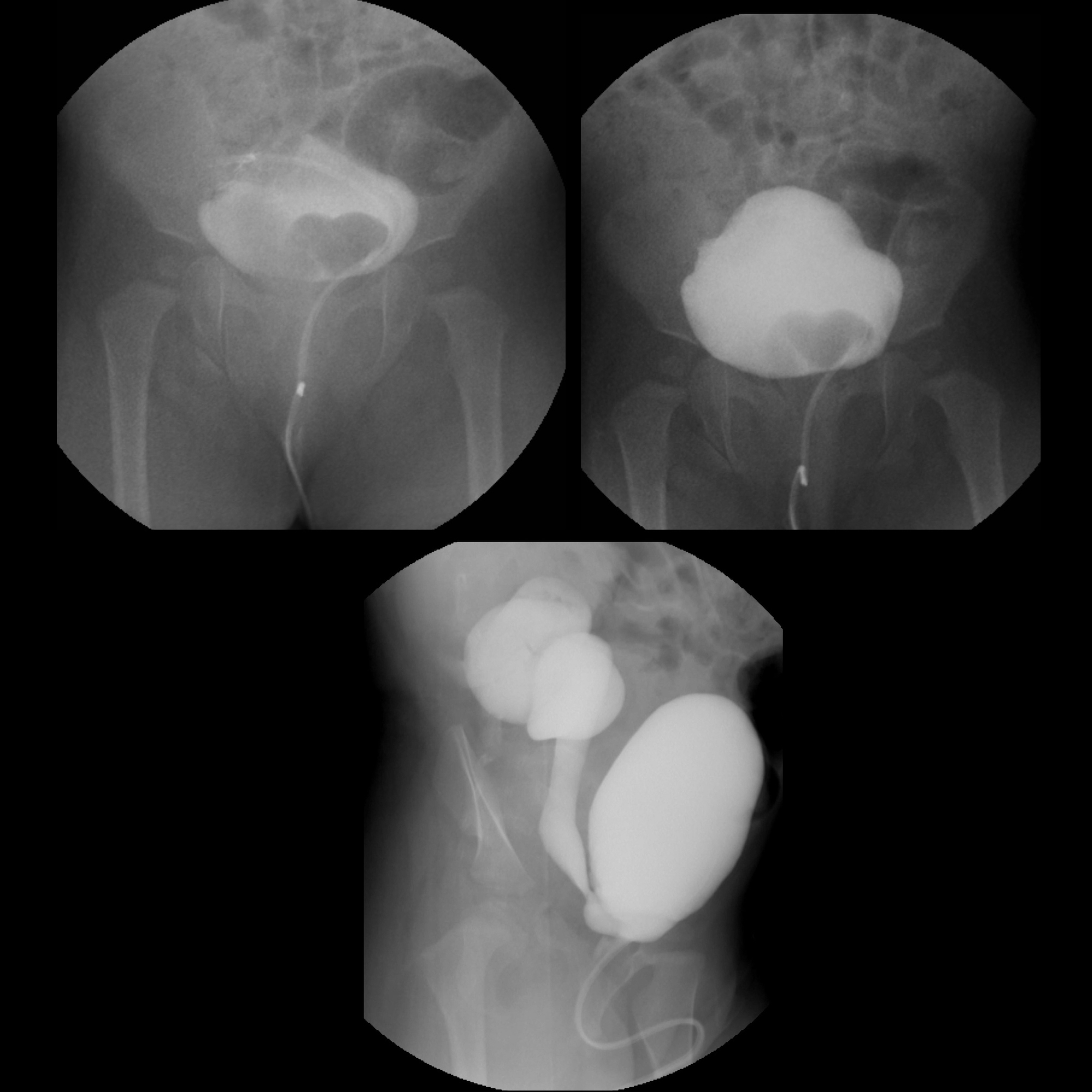 Pediatric Vesicoureteral Reflux | Pediatric Radiology Reference Article ...
